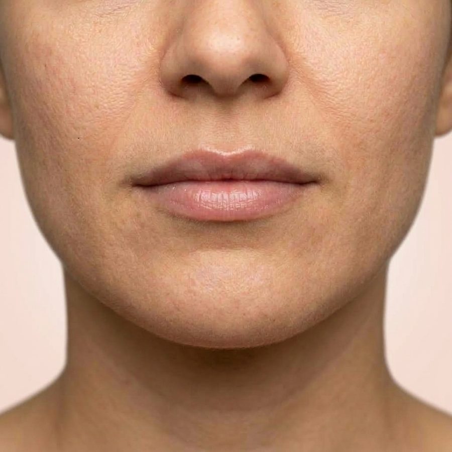 Illustration : lèvres hydratées au contour redessiné, après injection d'acide hyaluronique